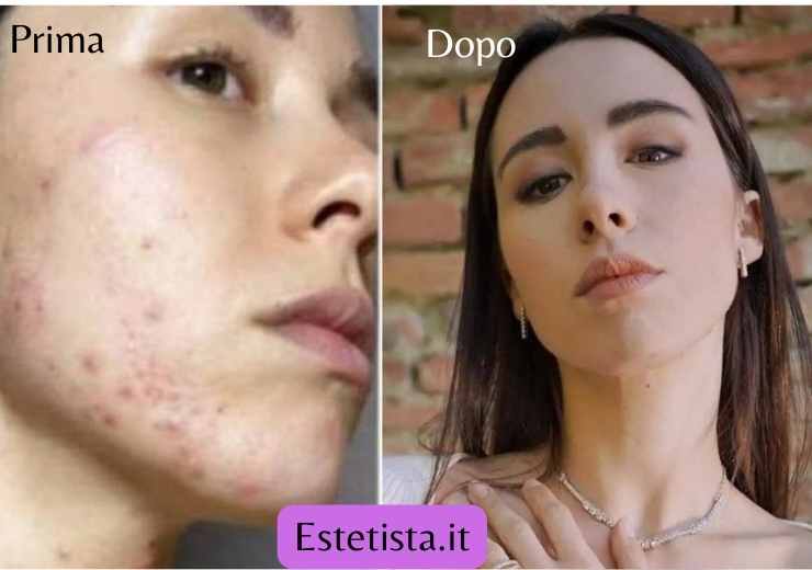 problema aurora ramazzotti acne risolto