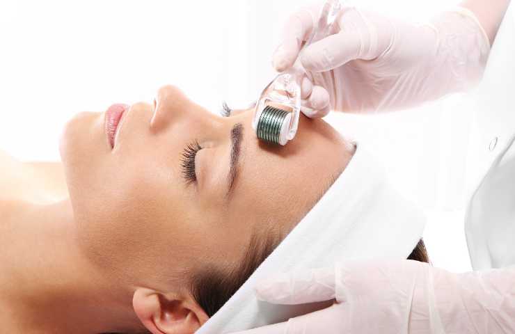 microneedling