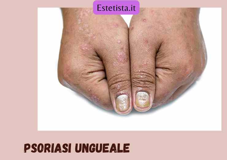 psoriasi ungueale