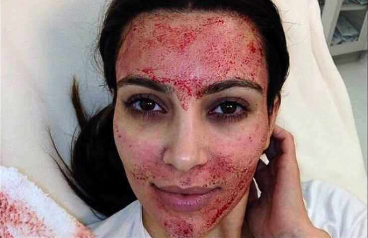trattamento anti age vampires facial