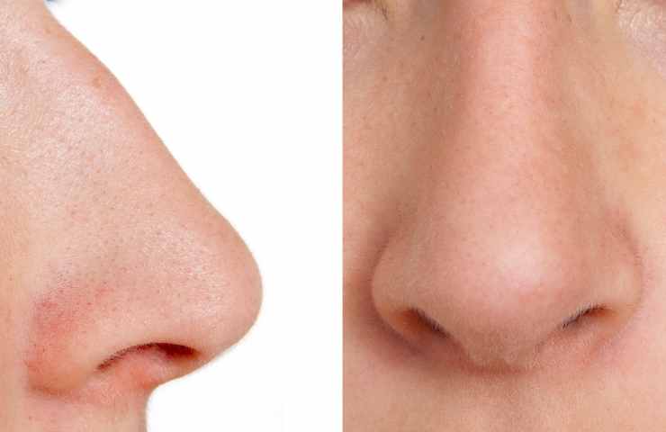 cambiamento della forma del naso
