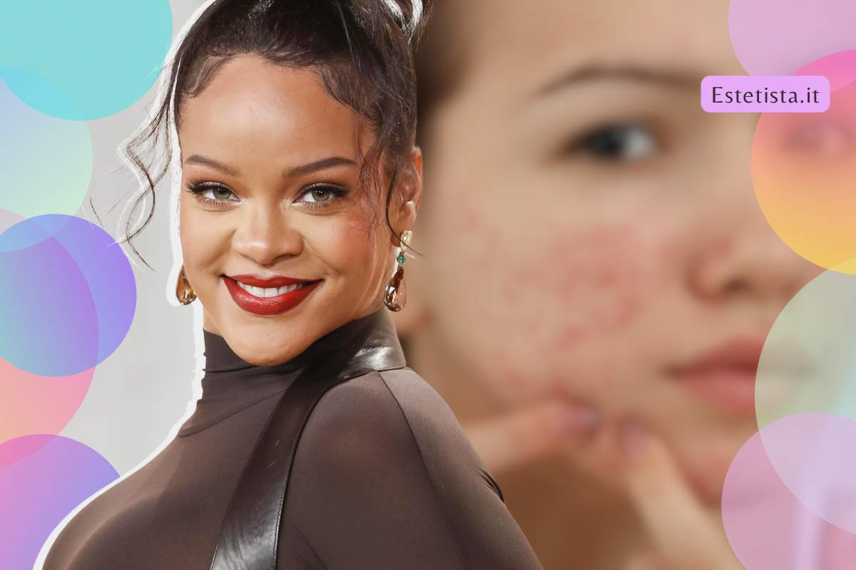 prodotto per brufoli di Rihanna