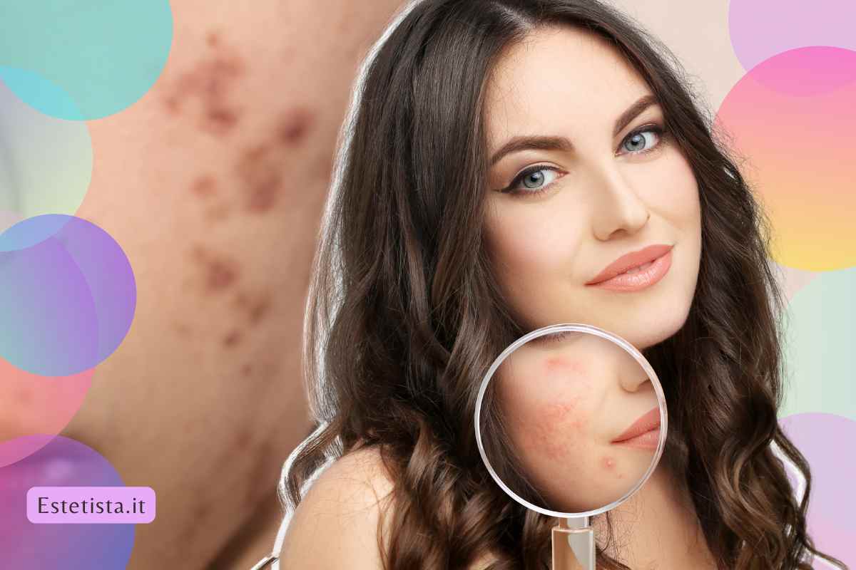 prodotto per cicatrici acne